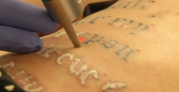 removal tattoo foto 2